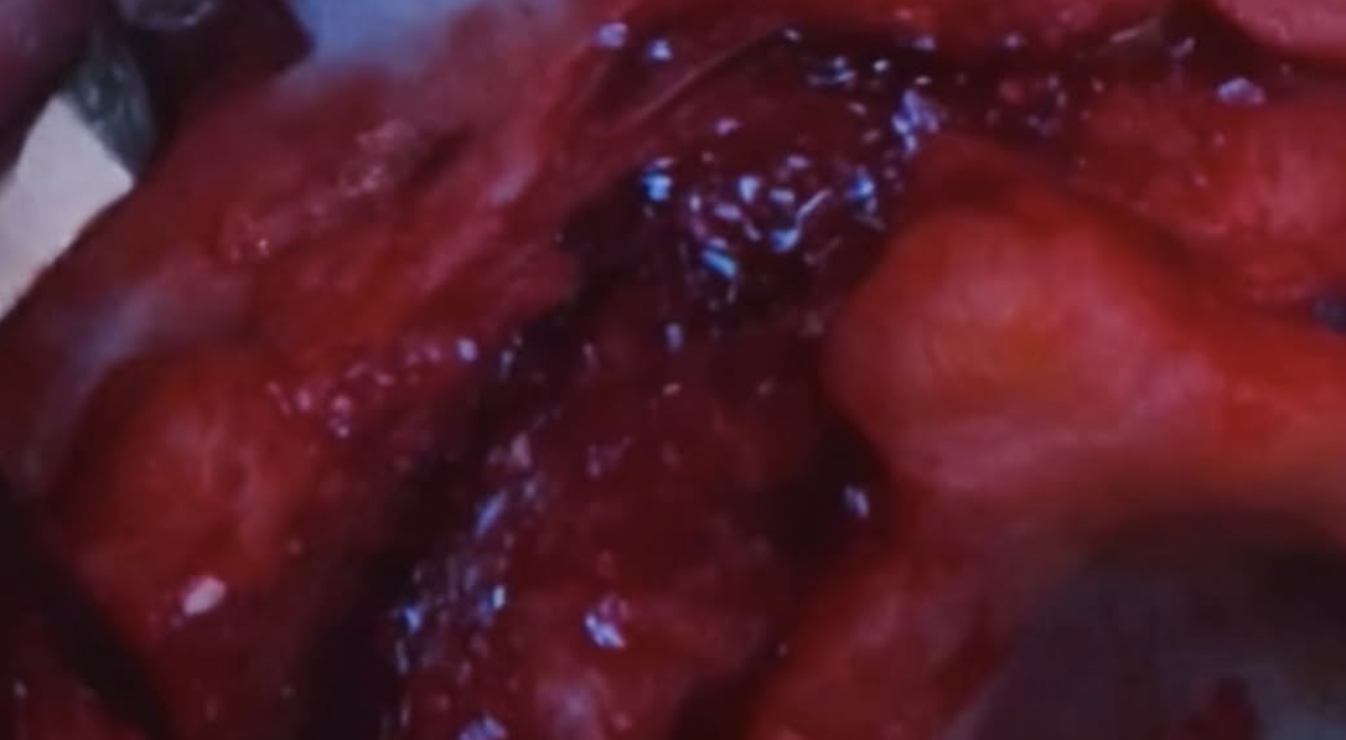 Bio-Oss in einem chirurgischen Arbeitsfeld mit Fluoreszenzlicht, Originalaufnahme aus der Geistlich-Schulungspräsentation