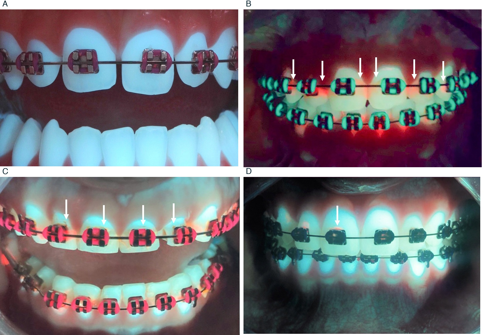 Vier originale Fluoreszenzbeispiele rund um Brackets: unauffällige Oberfläche, Biofilm, Demineralisation und initiale Karies, mit Originalpfeilen